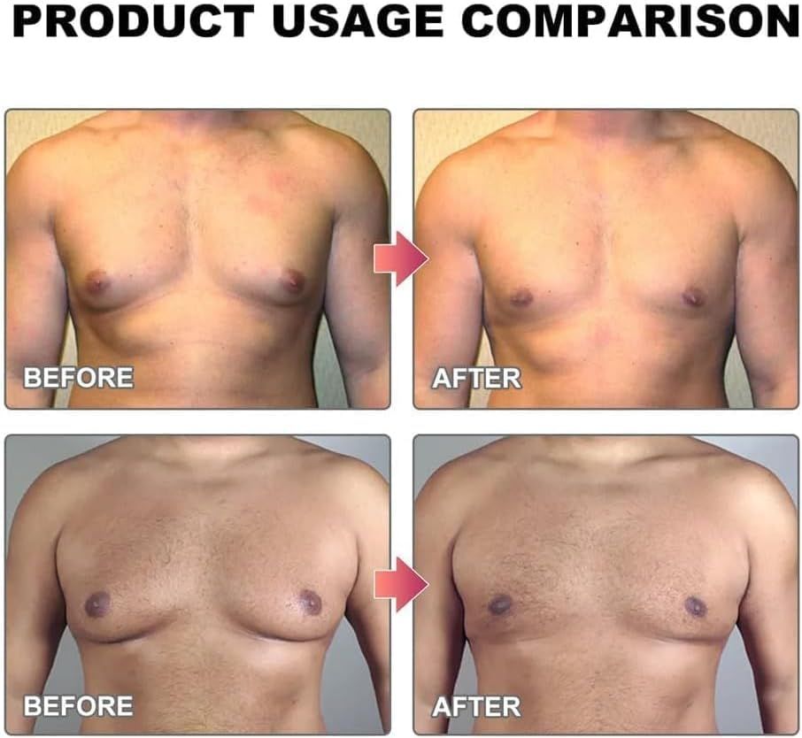 زيت التدفئة MenTherm Bee Venom Gynecomastia