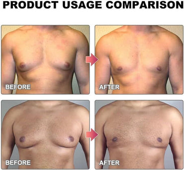 زيت التدفئة MenTherm Bee Venom Gynecomastia